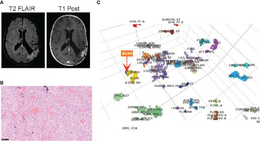 【佳学基因检测】基因检测发现少突胶质细胞瘤IDH 突变和 1p/19q 共缺失并揭示其靶向药物选择